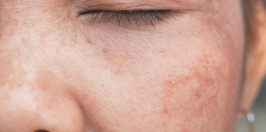 tratar las manchas de sol en la cara en el cuerpo - Ibáñez Farmacia